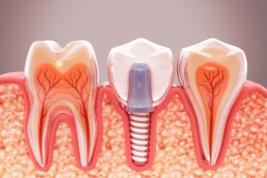 A Comprehensive Guide To Dental Implants In Huntingburg,Indiana